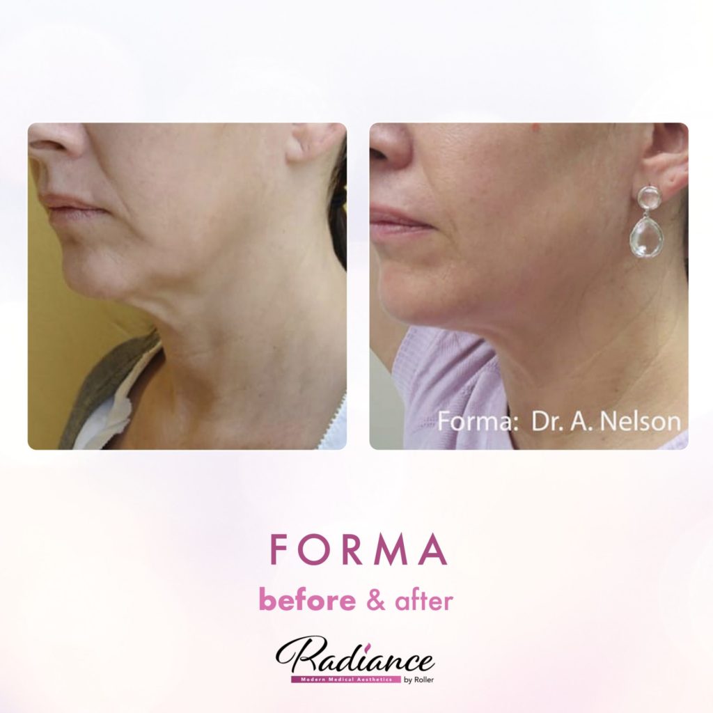 Forma Before & After Gallery - Patient 12666 - Image 1