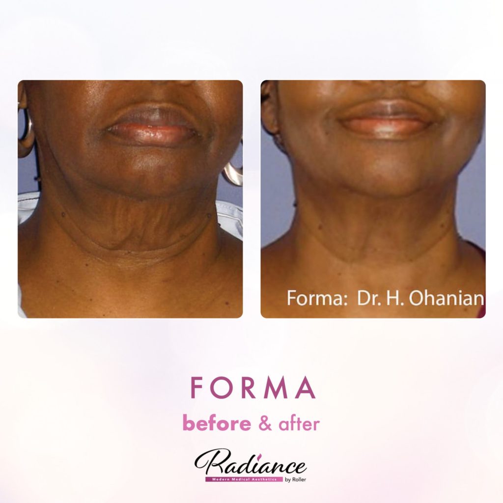 Forma Before & After Gallery - Patient 12661 - Image 1