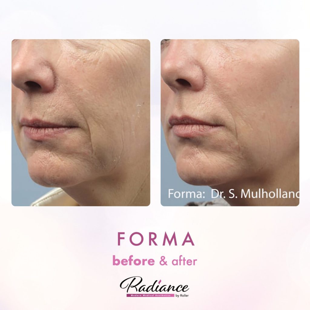 Forma Before & After Gallery - Patient 12660 - Image 1