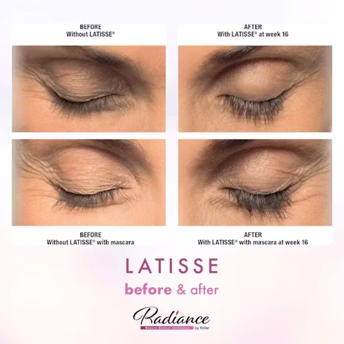 LATISSE® Before & After Gallery - Patient 13182 - Image 1