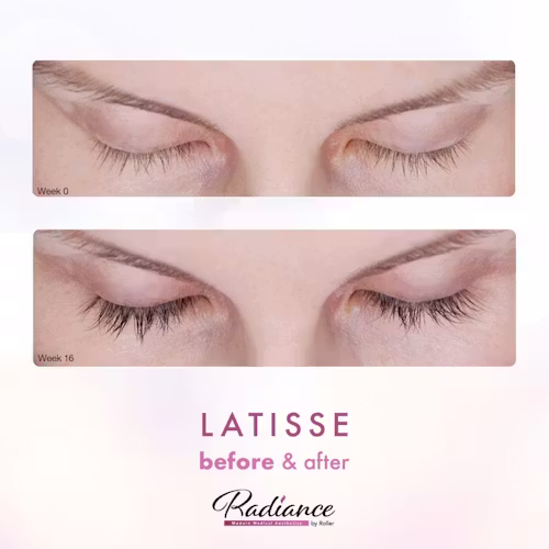 LATISSE® Before & After Gallery - Patient 13180 - Image 1
