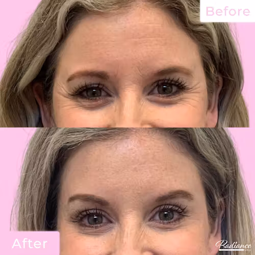 Jeuveau Before & After Gallery - Patient 12728 - Image 1
