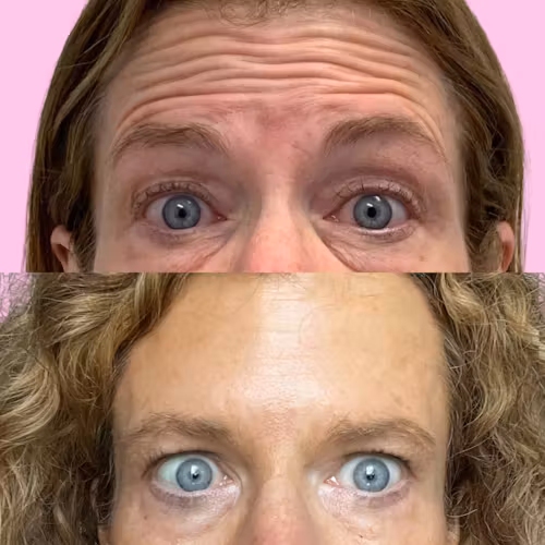 Jeuveau Before & After Gallery - Patient 12726 - Image 1