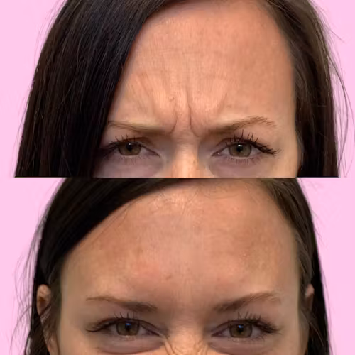 Jeuveau Before & After Gallery - Patient 12724 - Image 1
