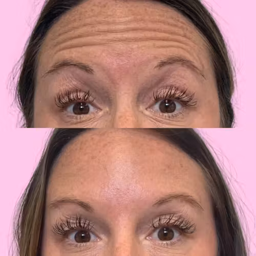 Jeuveau Before & After Gallery - Patient 12722 - Image 1