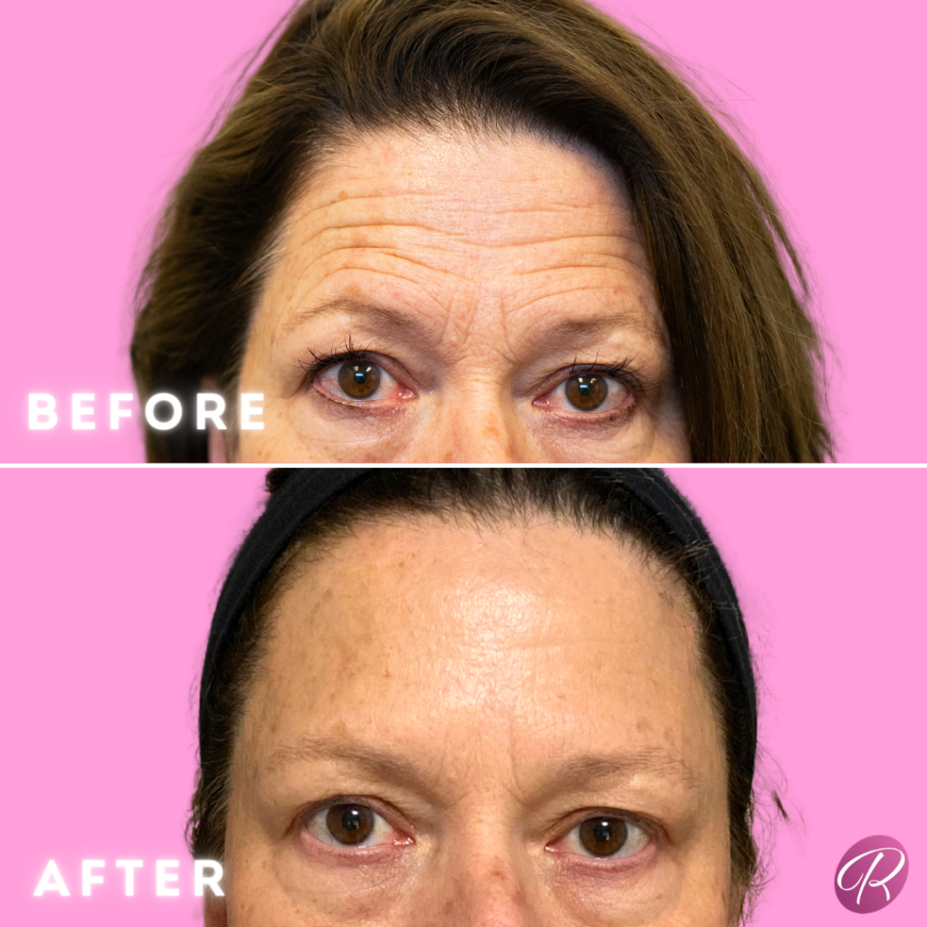 BOTOX Cosmetic Before & After Gallery - Patient 12552 - Image 1