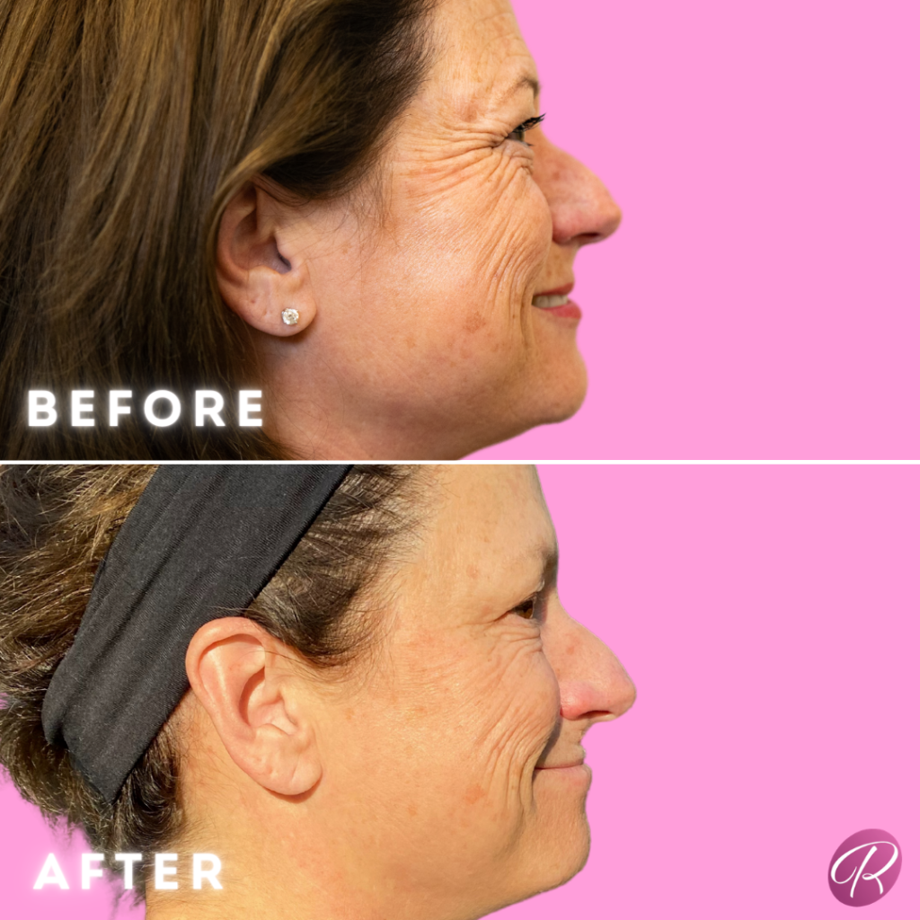 BOTOX Cosmetic Before & After Gallery - Patient 12552 - Image 2