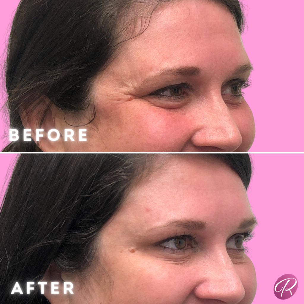 BOTOX Cosmetic Before & After Gallery - Patient 12549 - Image 2