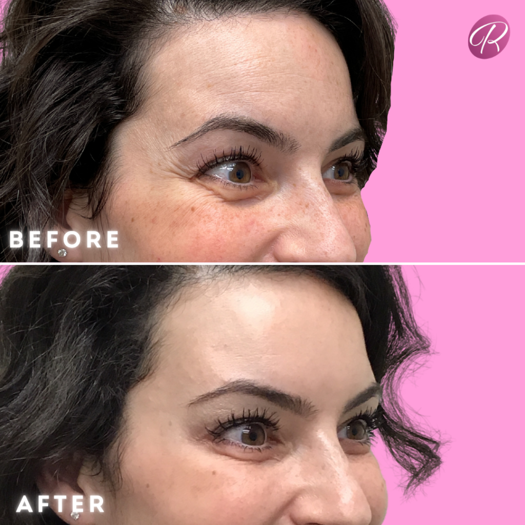 BOTOX Cosmetic Before & After Gallery - Patient 12546 - Image 2
