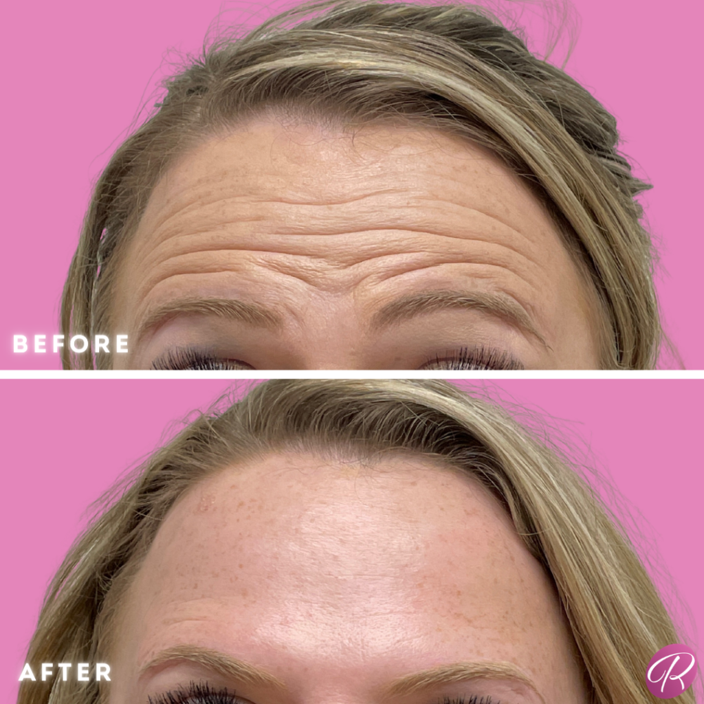 BOTOX Cosmetic Before & After Gallery - Patient 12543 - Image 2