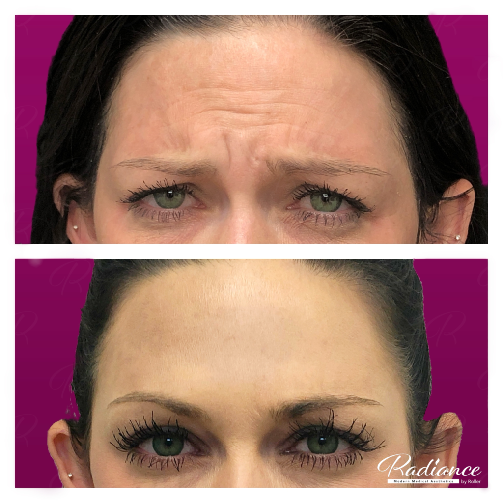 BOTOX Cosmetic Before & After Gallery - Patient 12537 - Image 1
