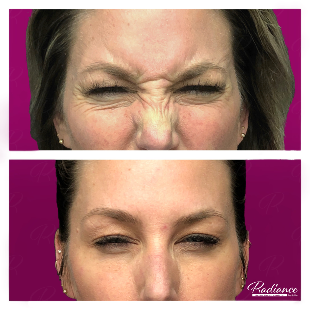 BOTOX Cosmetic Before & After Gallery - Patient 12534 - Image 2