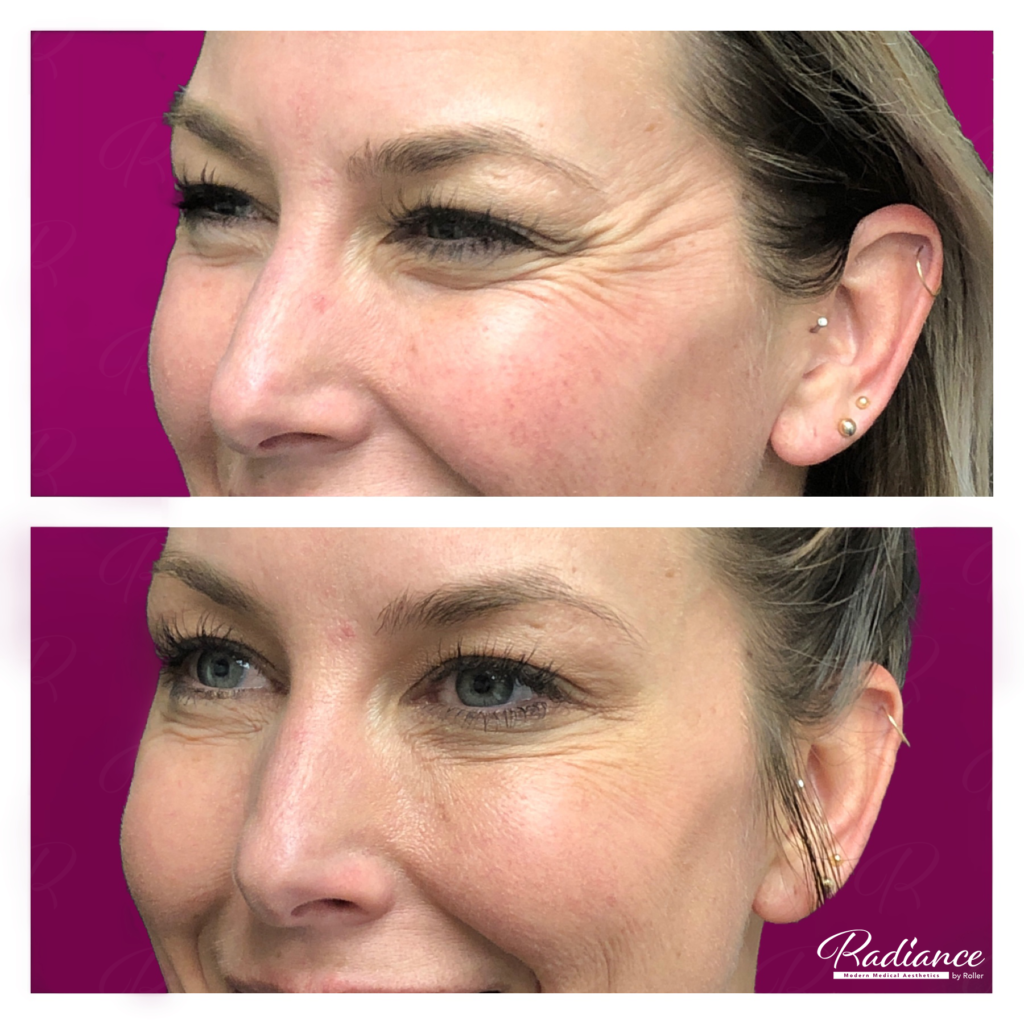 BOTOX Cosmetic Before & After Gallery - Patient 12534 - Image 3