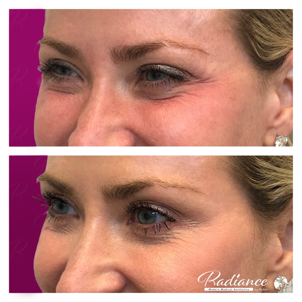BOTOX Cosmetic Before & After Gallery - Patient 12529 - Image 1