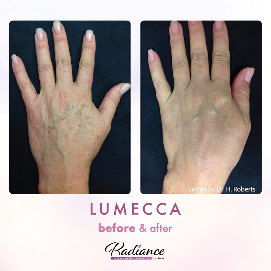 Lumecca Before & After Gallery - Patient 12688 - Image 1