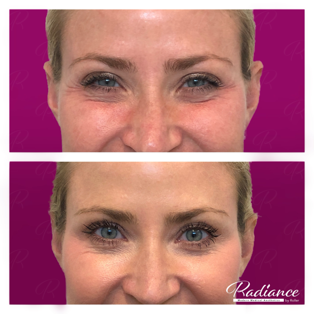 BOTOX Cosmetic Before & After Gallery - Patient 12529 - Image 2