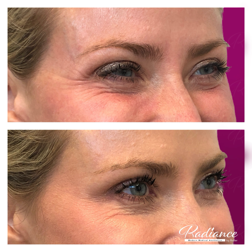 BOTOX Cosmetic Before & After Gallery - Patient 12529 - Image 3