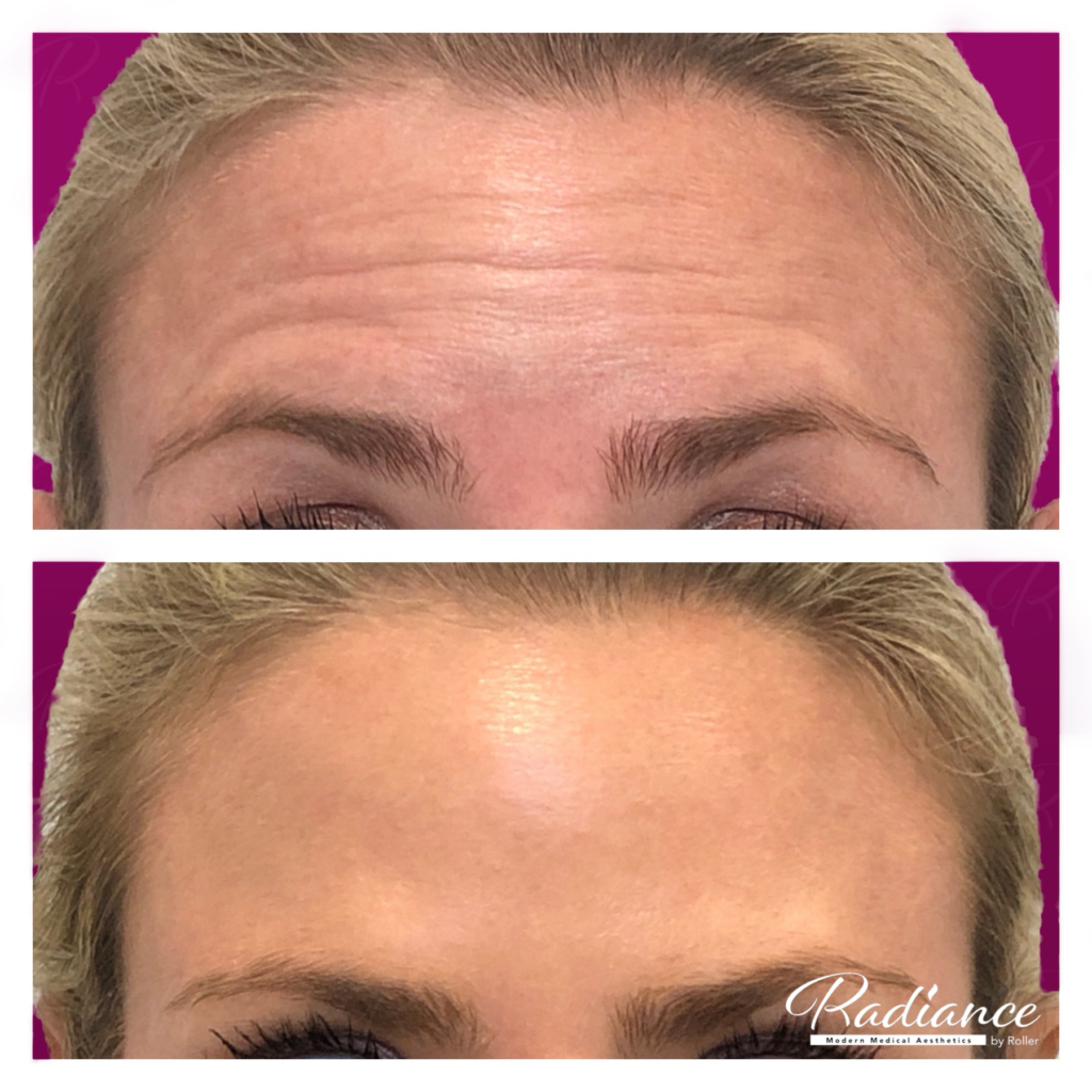 BOTOX Cosmetic Before & After Gallery - Patient 12529 - Image 4