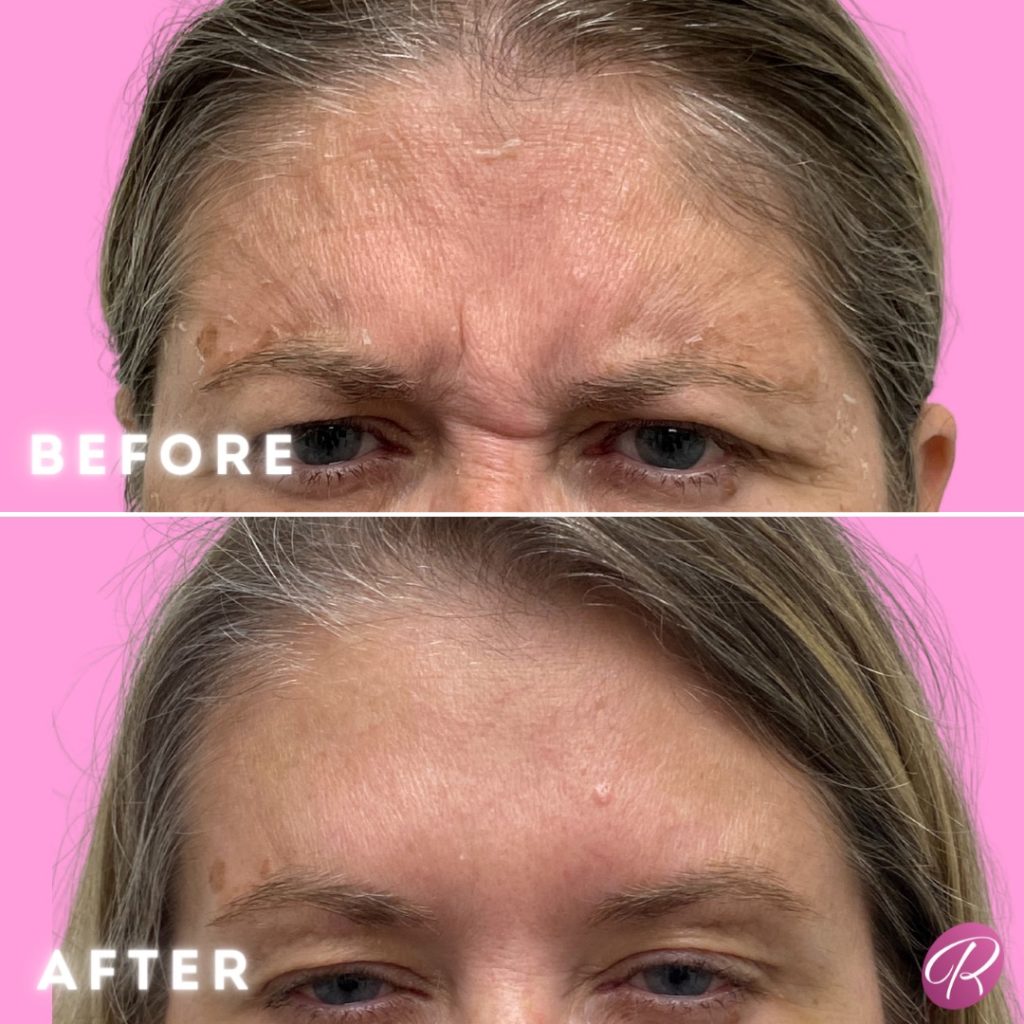 Jeuveau Before & After Gallery - Patient 12706 - Image 1