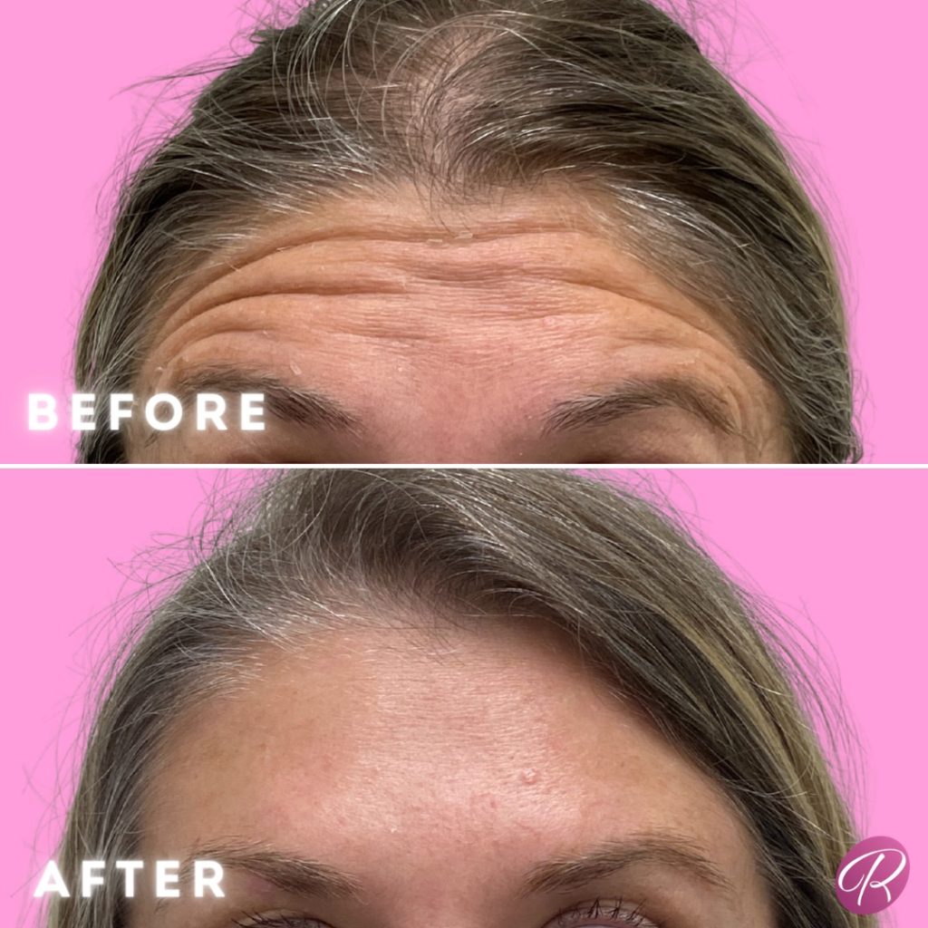 Jeuveau Before & After Gallery - Patient 12706 - Image 2