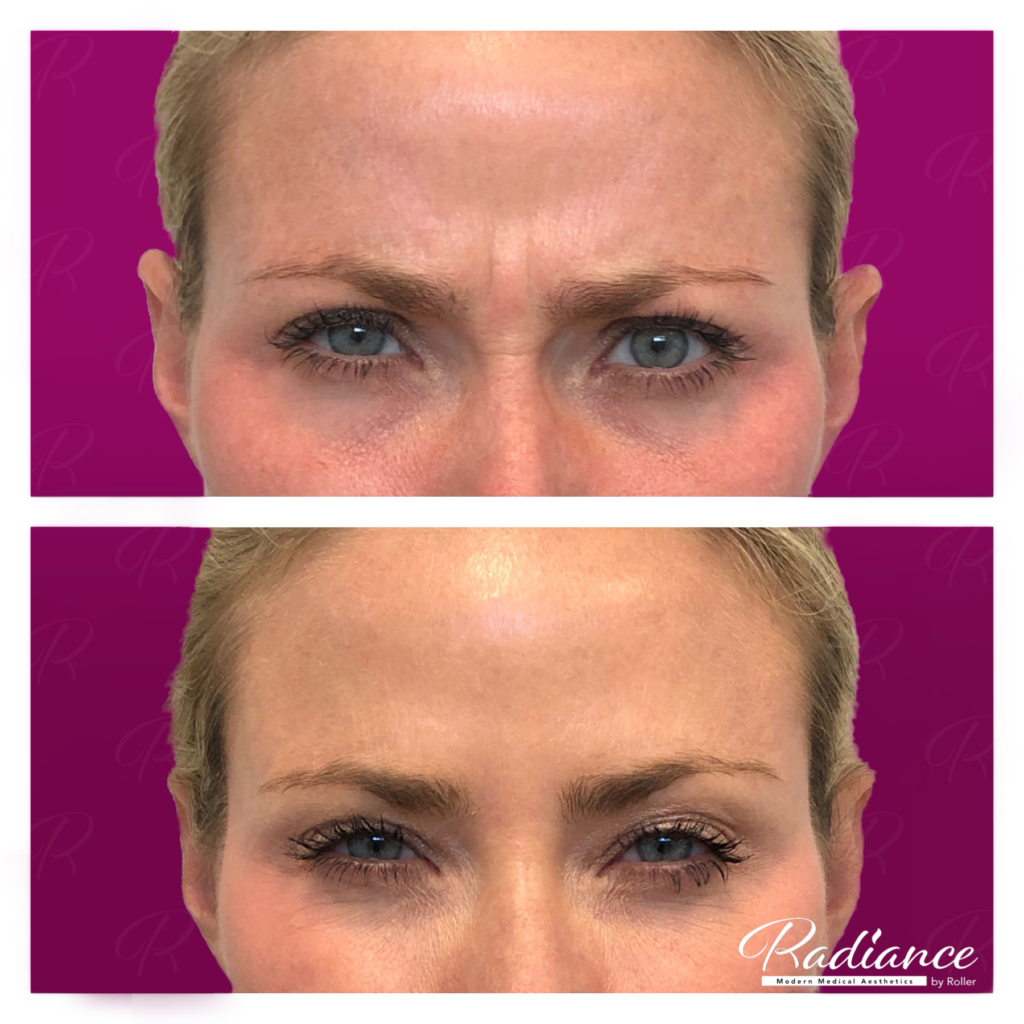 BOTOX Cosmetic Before & After Gallery - Patient 12529 - Image 5