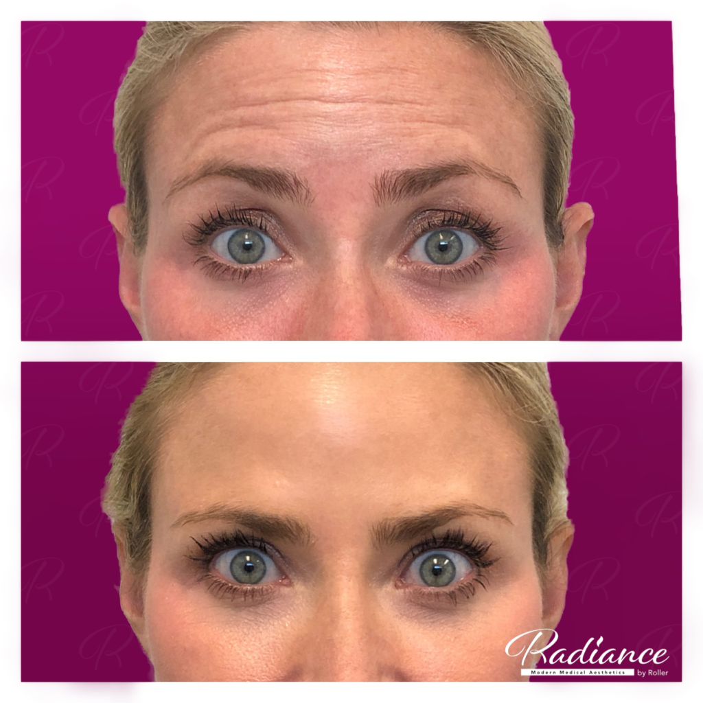 BOTOX Cosmetic Before & After Gallery - Patient 12529 - Image 6