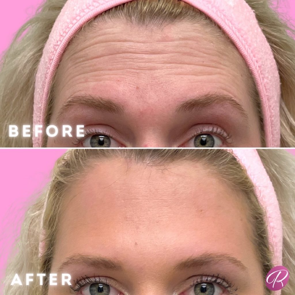 Juvederm Before & After Gallery - Patient 12739 - Image 1