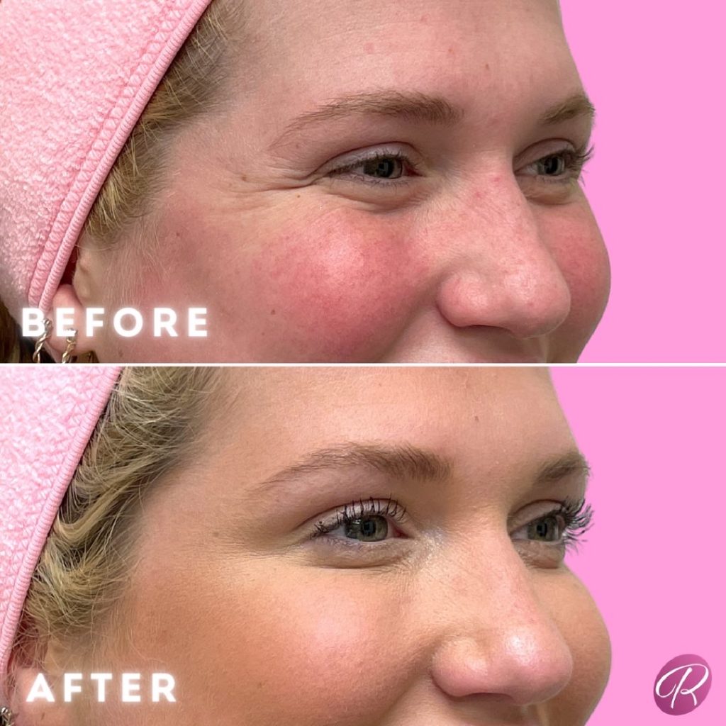Juvederm Before & After Gallery - Patient 12739 - Image 2