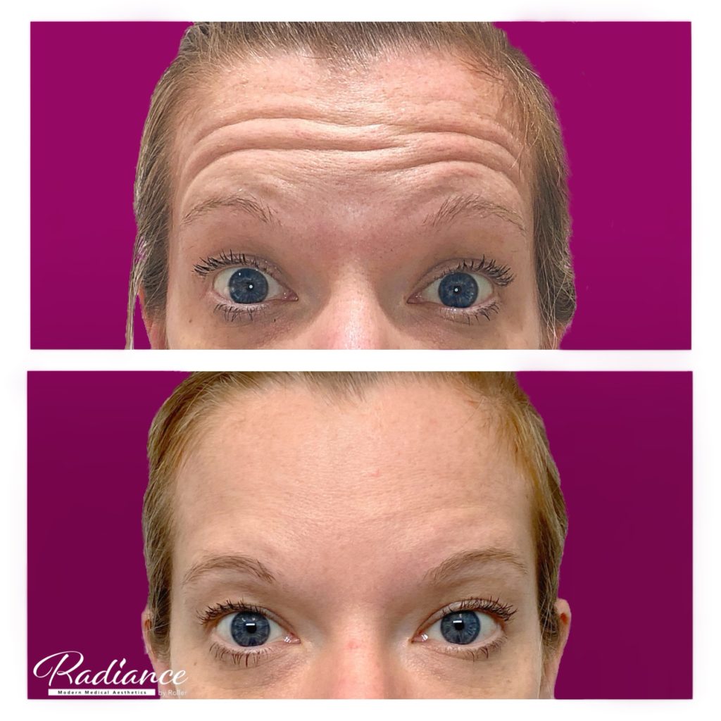 BOTOX Cosmetic Before & After Gallery - Patient 12526 - Image 2
