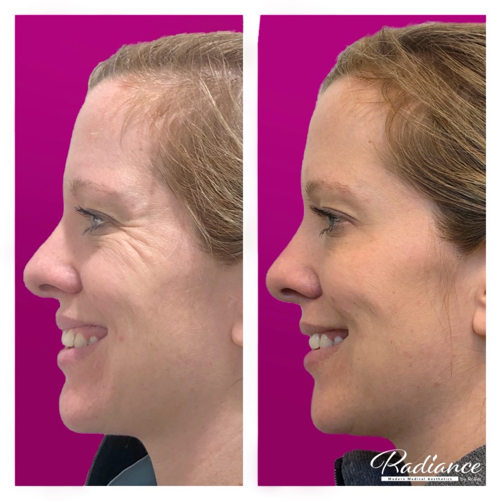 BOTOX Cosmetic Before & After Gallery - Patient 12526 - Image 3