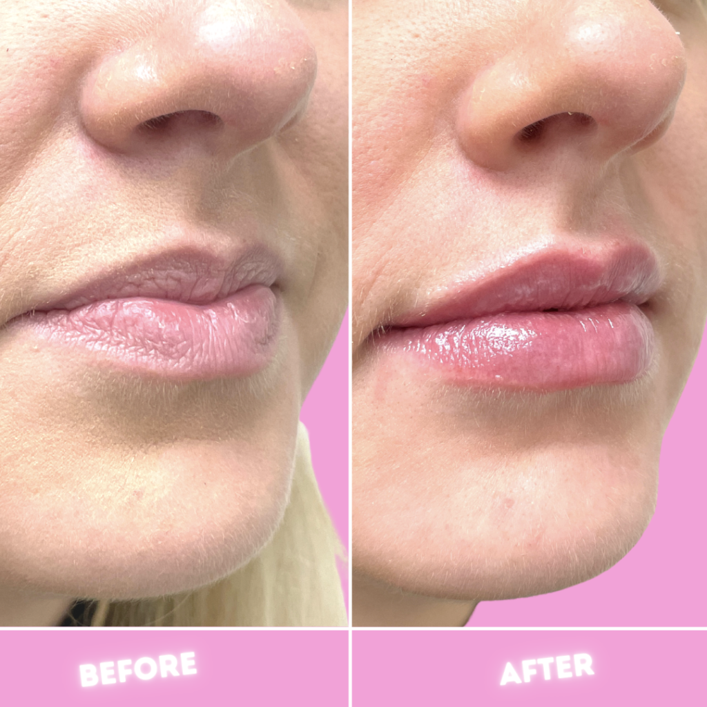 Juvederm Before & After Gallery - Patient 12733 - Image 1