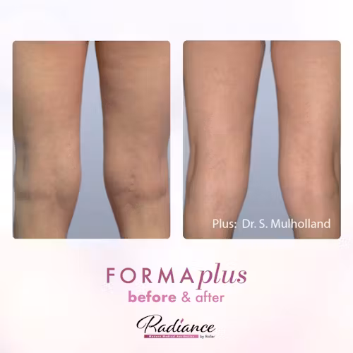 FormaPlus Before & After Gallery - Patient 13110 - Image 1