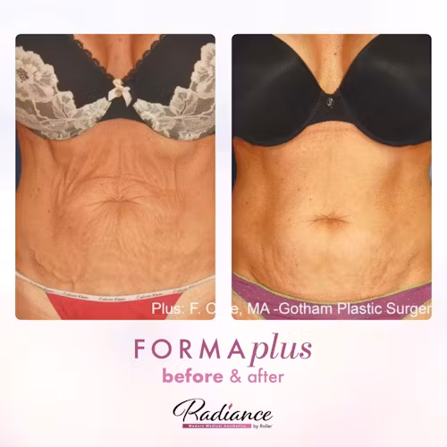 FormaPlus Before & After Gallery - Patient 13108 - Image 1