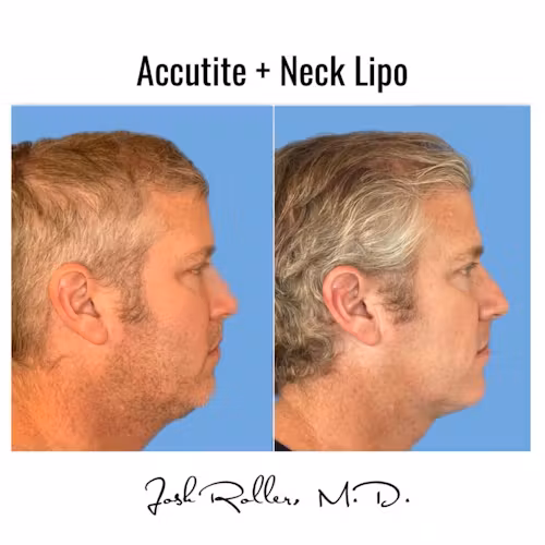 Accutite Before & After Gallery - Patient 13103 - Image 1