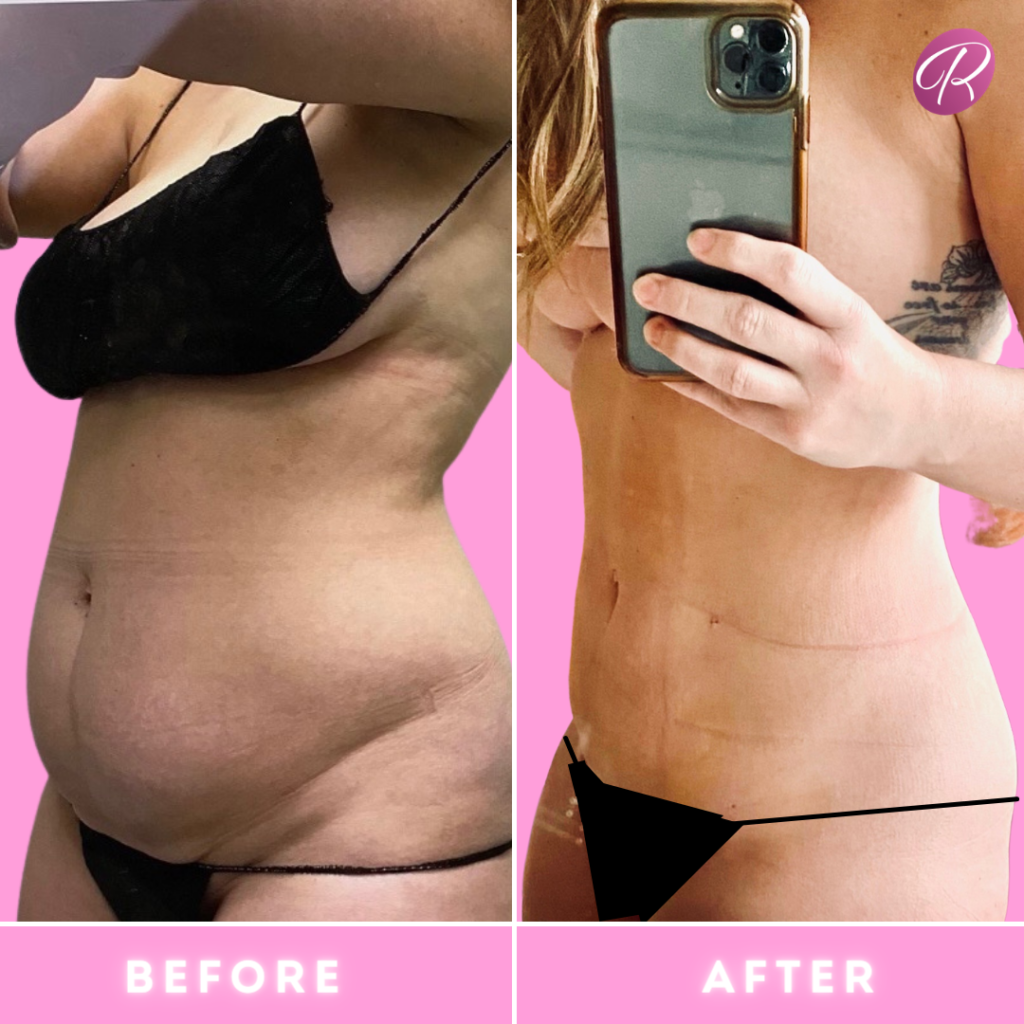 BodyTite Before & After Gallery - Patient 12826 - Image 1