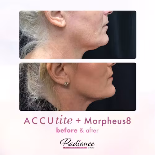 Accutite Before & After Gallery - Patient 13105 - Image 1