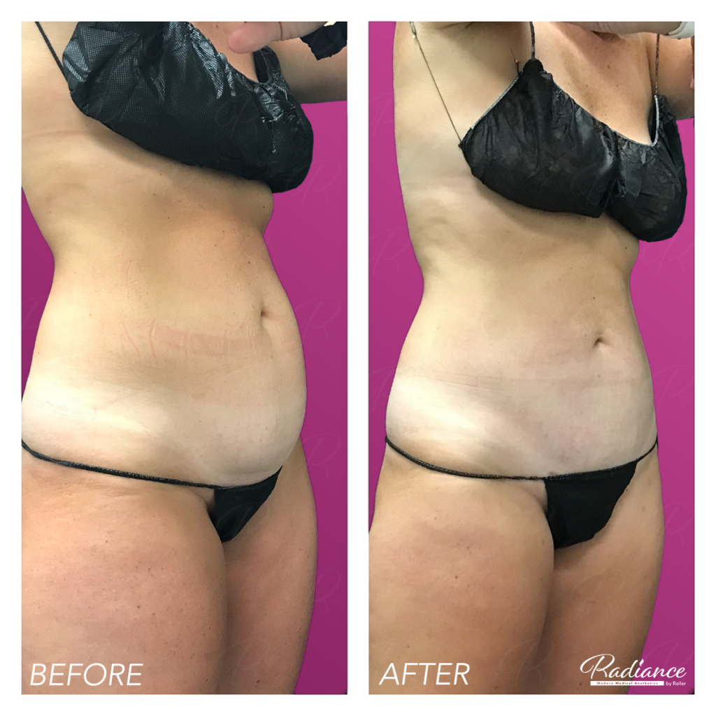 BodyTite Before & After Gallery - Patient 12823 - Image 1