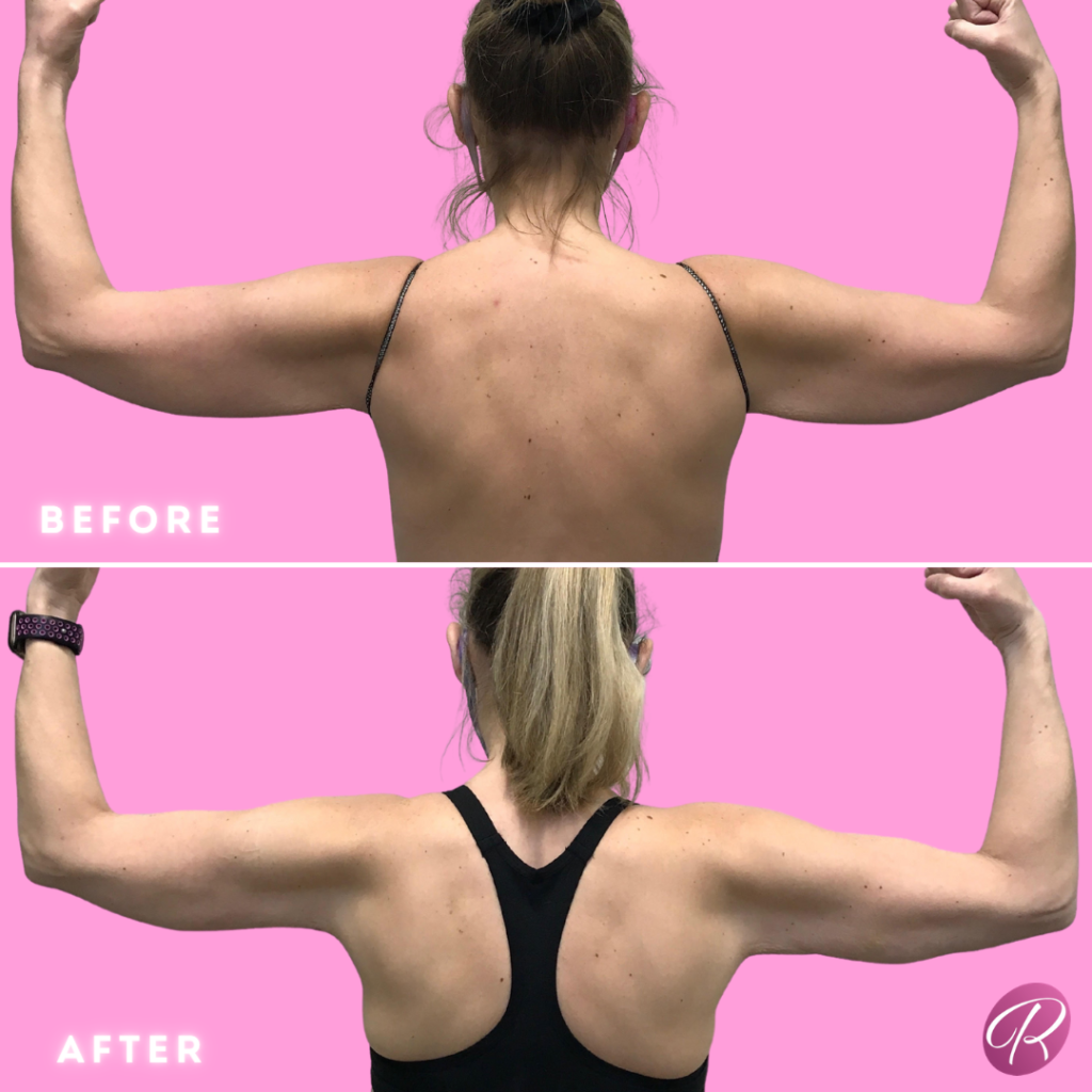 BodyTite Before & After Gallery - Patient 12820 - Image 1