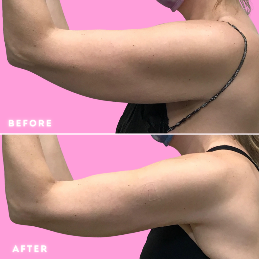 BodyTite Before & After Gallery - Patient 12820 - Image 4