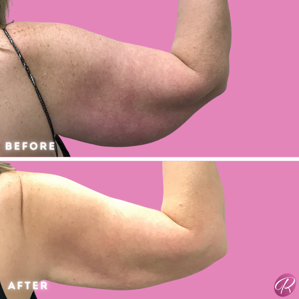 BodyTite Before & After Gallery - Patient 12817 - Image 1