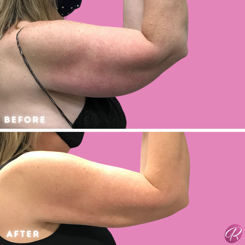 BodyTite Before & After Gallery - Patient 12817 - Image 3