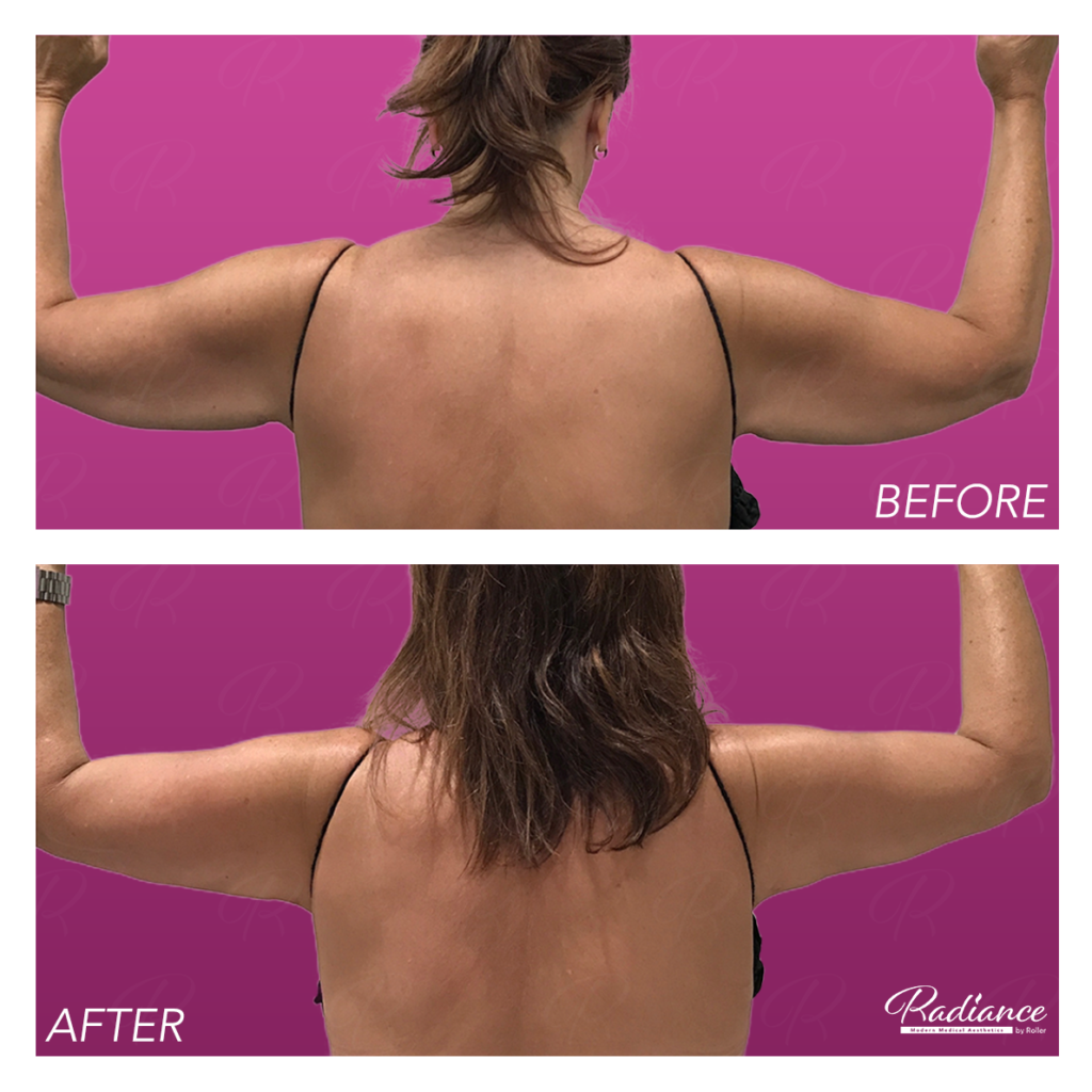 BodyTite Before & After Gallery - Patient 12814 - Image 1