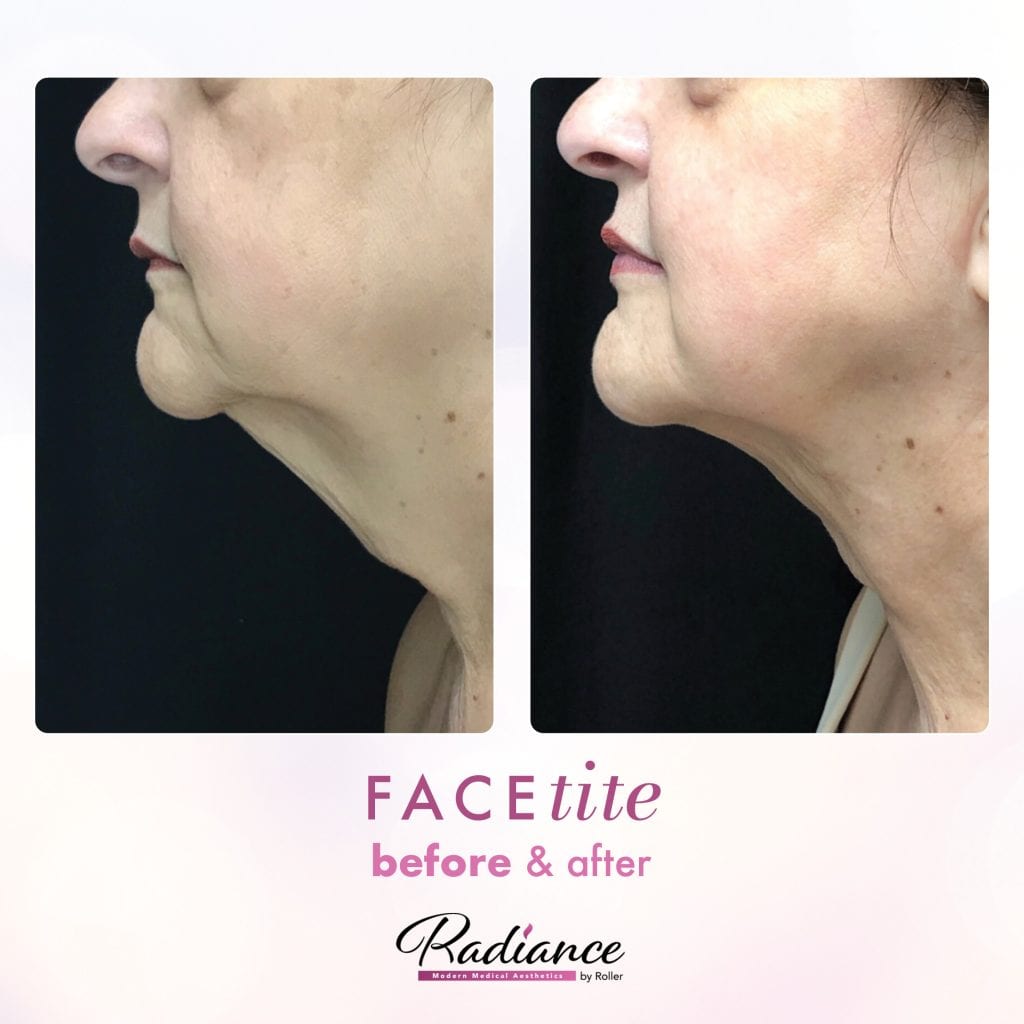 FaceTite Before & After Gallery - Patient 12850 - Image 1