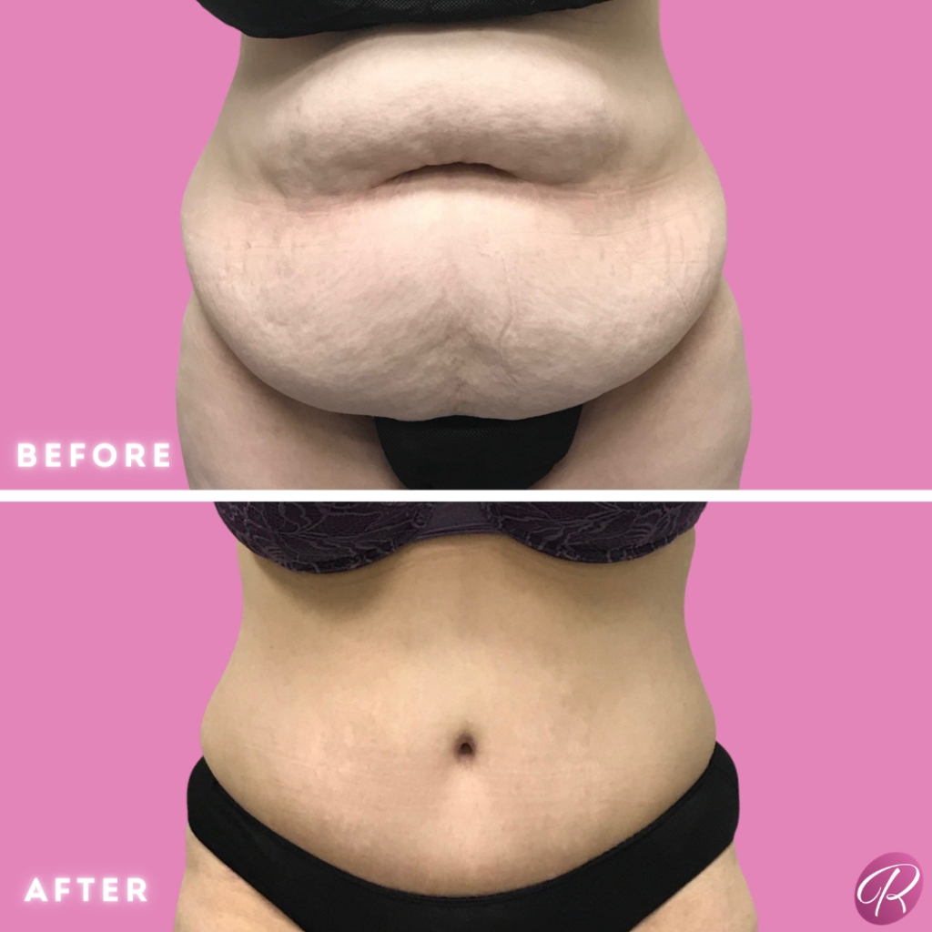 Tummy Tuck and Abdominoplasty Before & After Gallery - Patient 13153 - Image 1