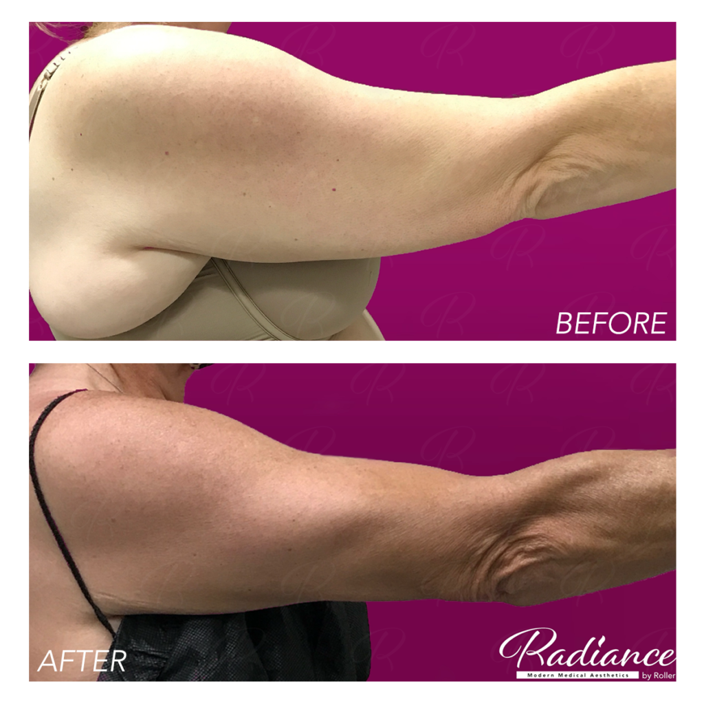 BodyTite Before & After Gallery - Patient 12811 - Image 1