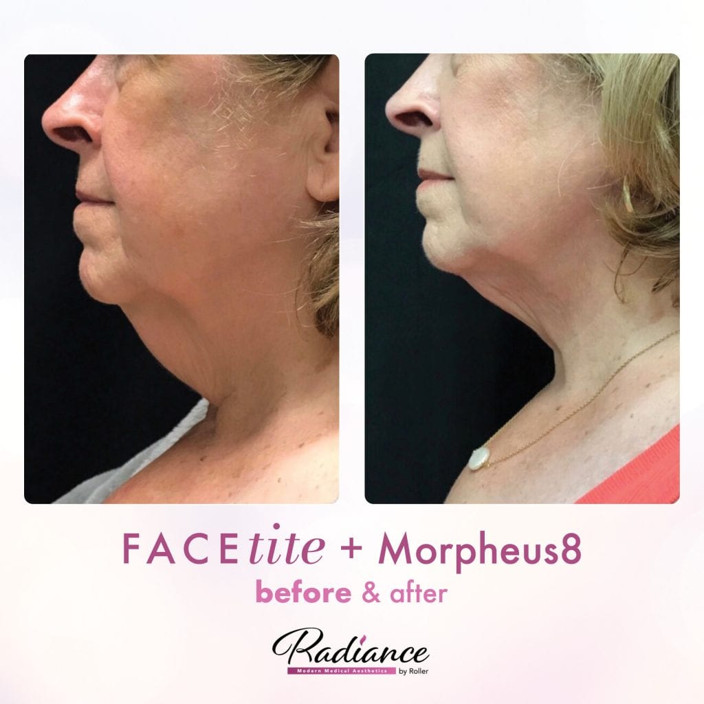 FaceTite Before & After Gallery - Patient 12838 - Image 1