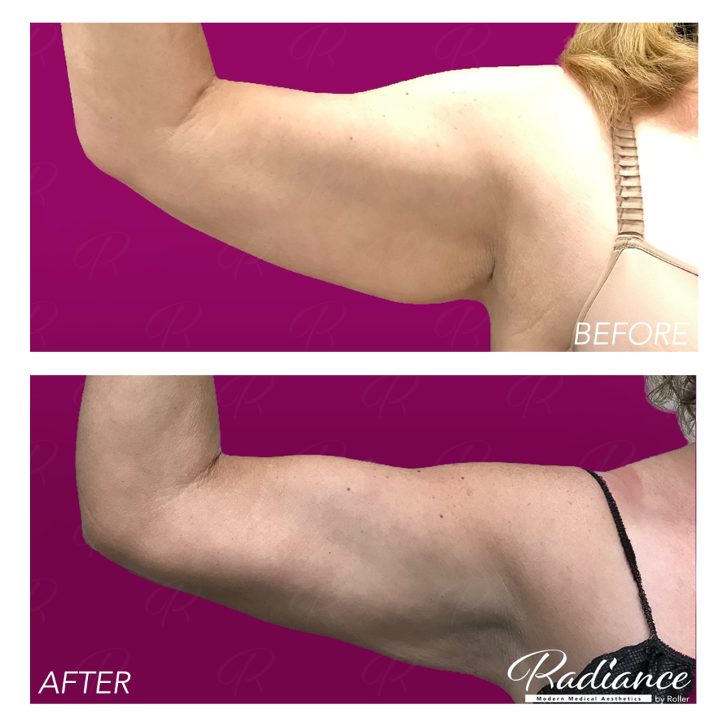 BodyTite Before & After Gallery - Patient 12811 - Image 6