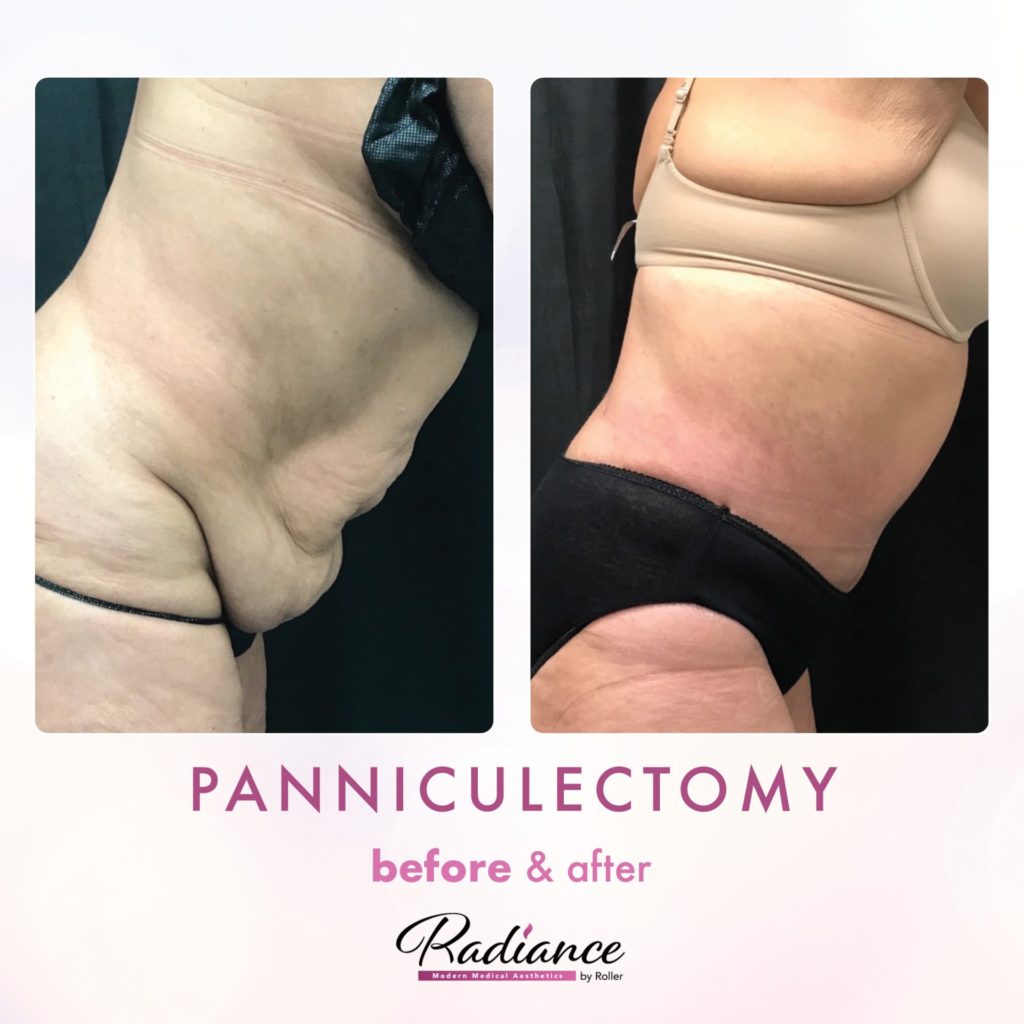 Tummy Tuck and Abdominoplasty Before & After Gallery - Patient 13136 - Image 1