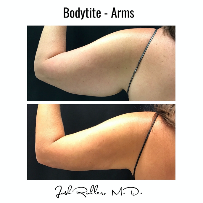BodyTite Before & After Gallery - Patient 12808 - Image 1