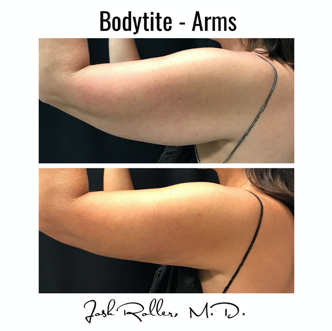 BodyTite Before & After Gallery - Patient 12808 - Image 2